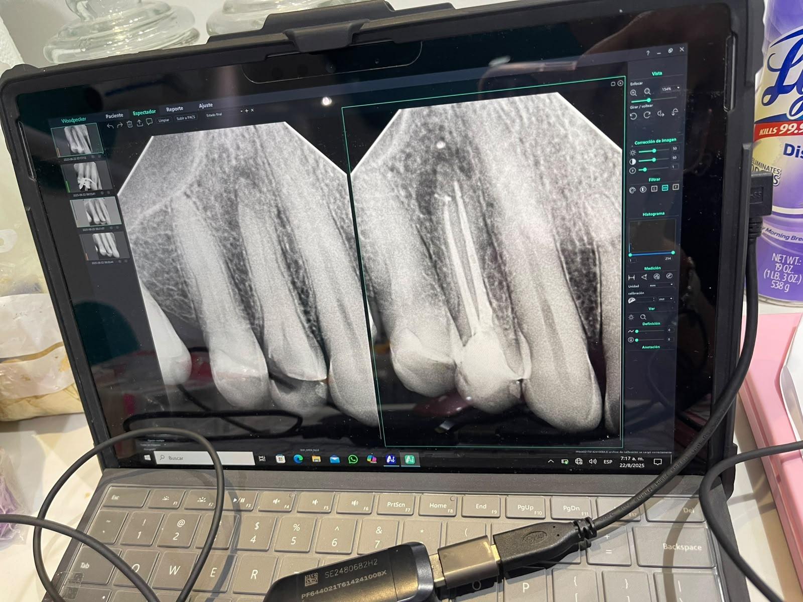 Radiografía digital de un tratamiento de conducto en la pantalla del consultorio